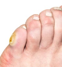 corn toe