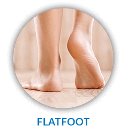 Flat Feet & Fallen Arches Treatment in Corsicana, Waxahachie & Ennis, TX