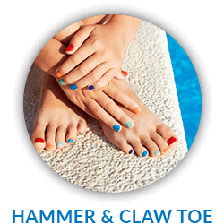 Hammertoe & Claw Toe Treatment in Corsicana, Waxahachie & Ennis, TX