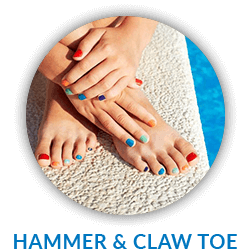 hammertoe