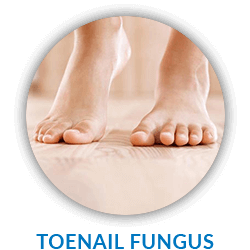 fungus toenail