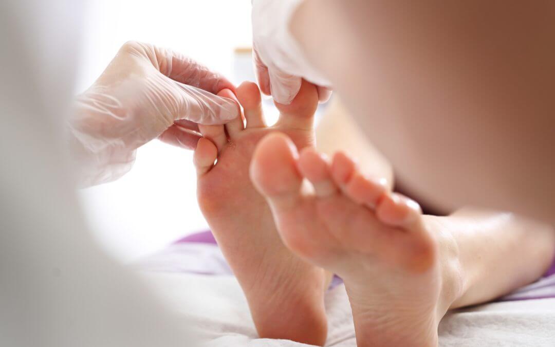 An In Depth Guide To Athletes Foot and How To Treat It