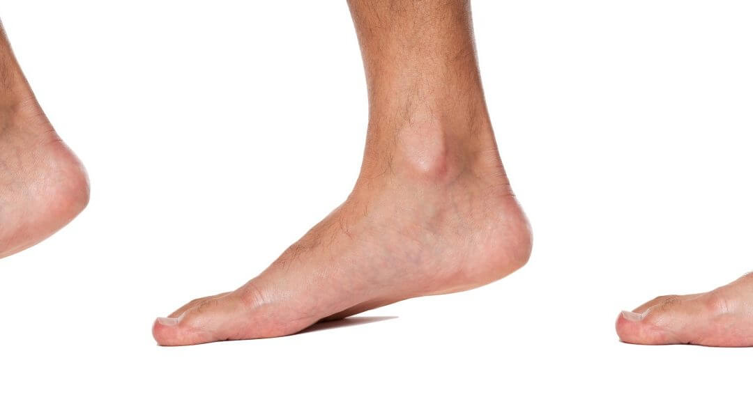 flat feet