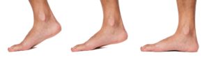 flat feet