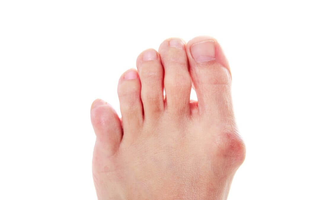 What is a Foot Bunion?