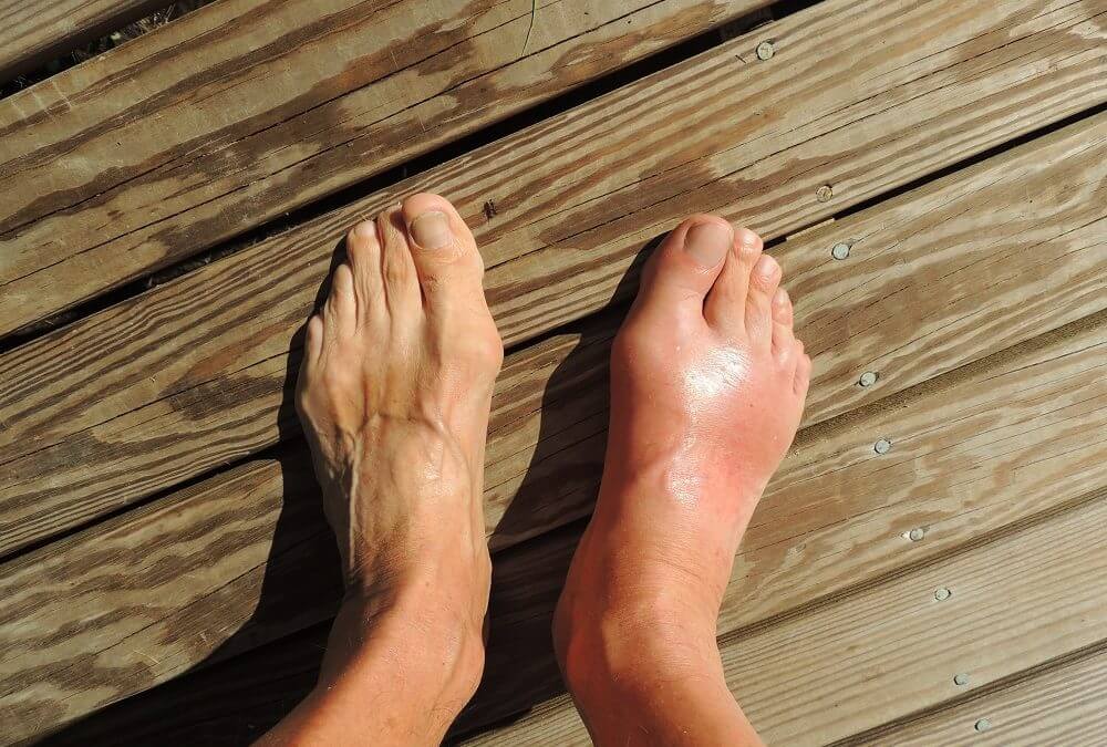 A Gout Guide: What It Is, What Causes It and How to Treat It