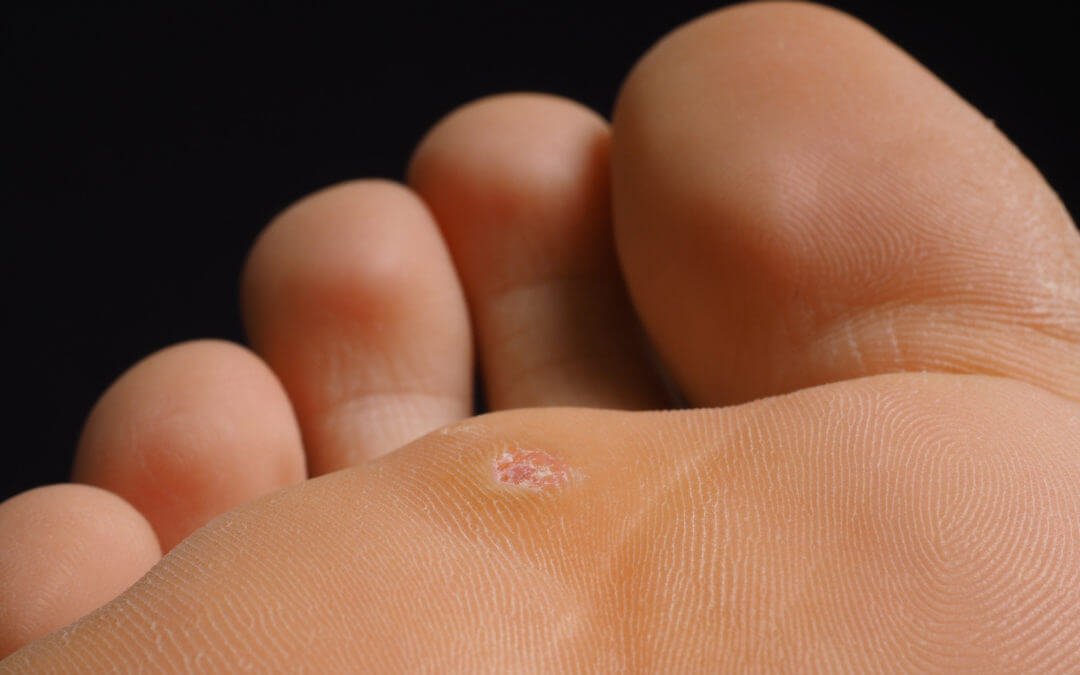 plantar wart