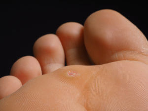 plantar wart