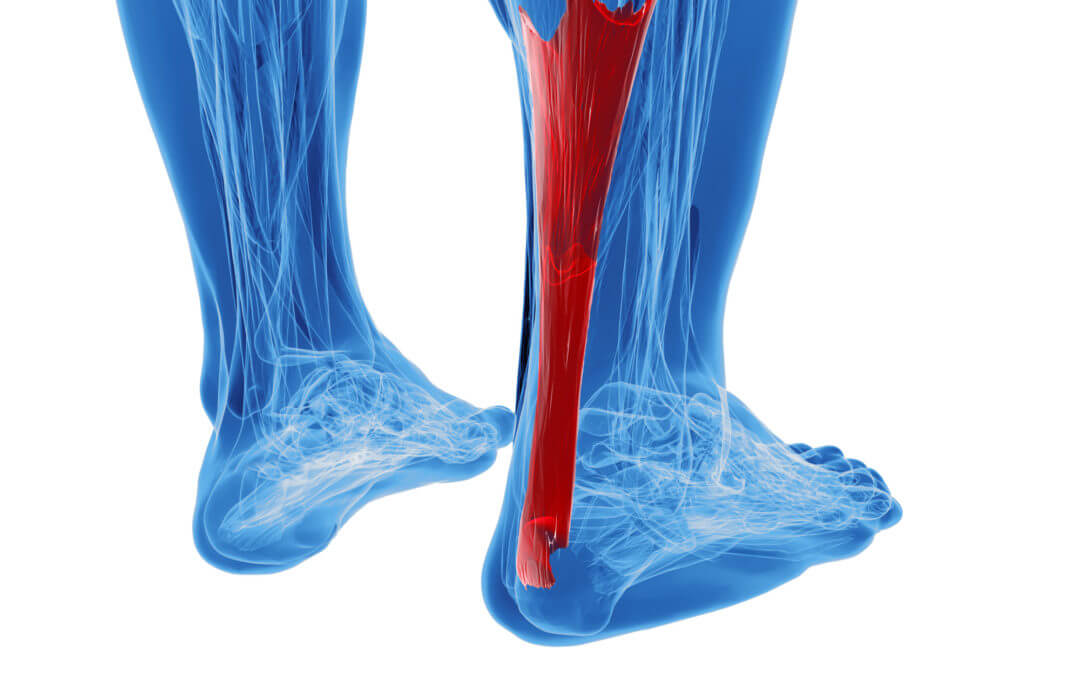 achilles tendinitis