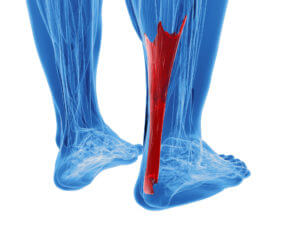 achilles tendinitis