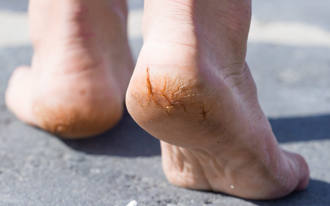 Cracked Heel Causes - What causes cracked Heels