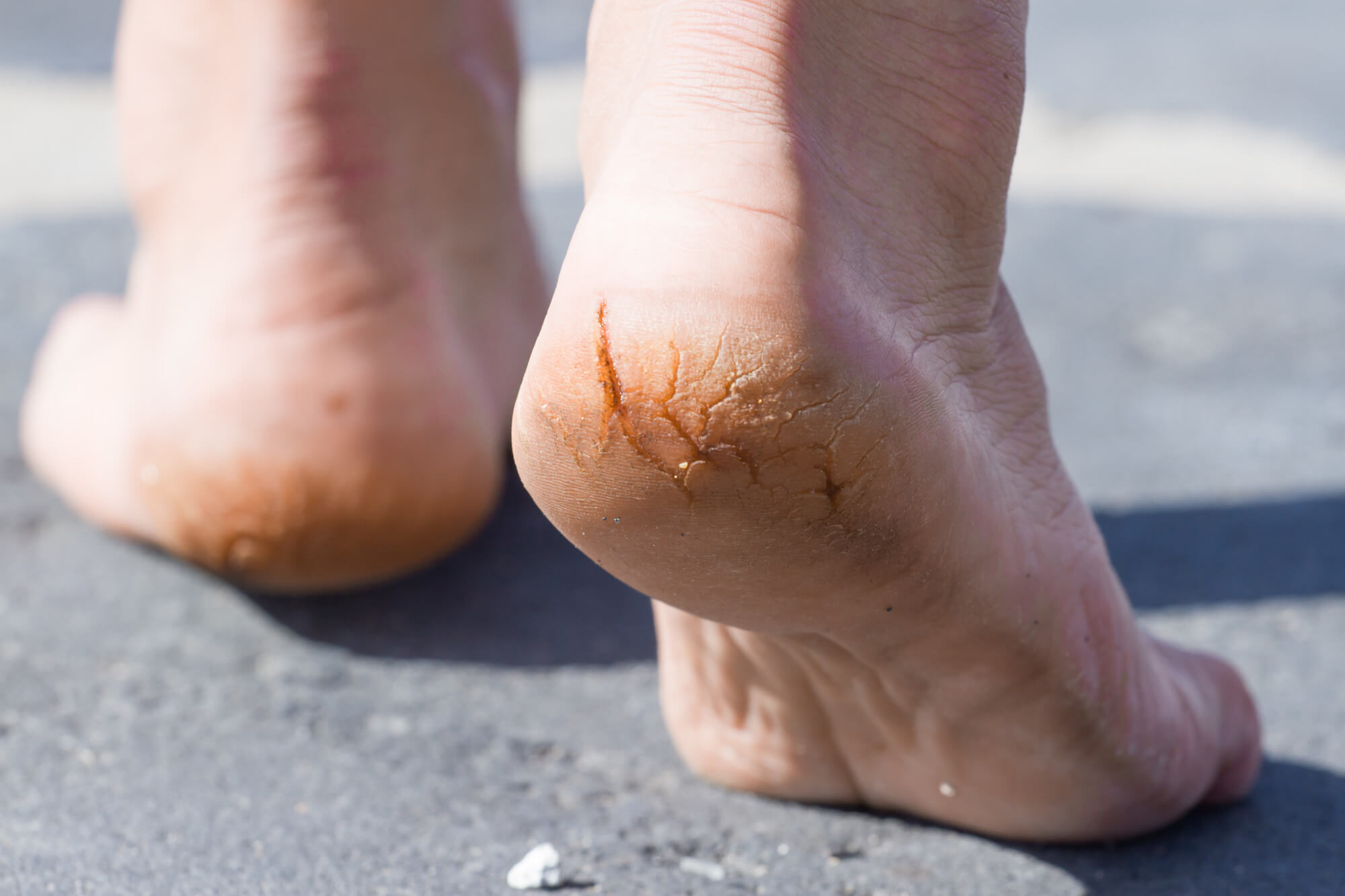 Kirkby Podiatry / Chiropody - Before and after. Dry, callus, hard skin  removed professionally in a sterile technique. Callus/ hard skin if not  treated could lead to complications such as cracked heels