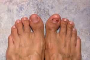 hammer toe