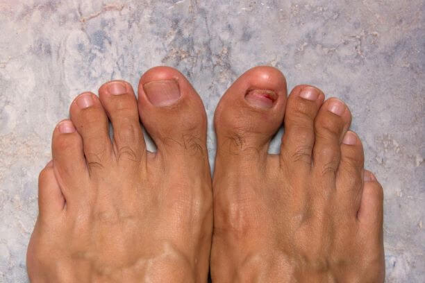 What Is Hammertoe? The Causes and Symptoms