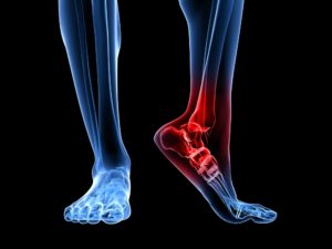 heel-bone-pain-2-300x225