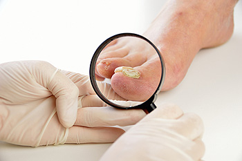 What Are Common Symptoms of Toenail Fungus?