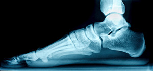 What Are Flexible Flat Feet?