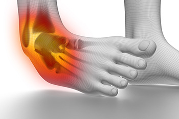 Ankle Sprains Are a Common Ankle Injury