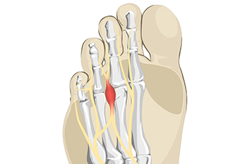 Stretches That May Help the Pain of Morton’s Neuroma