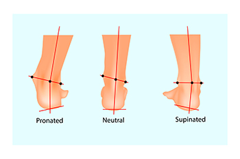 Can Overpronation Be Corrected?