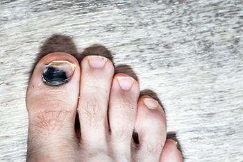 Definition and Causes of Black Toenails