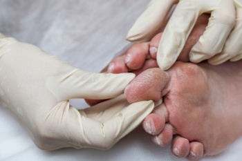 How Diabetes Causes Foot Pain