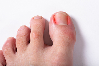 ngrown Toenails Facts