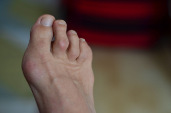 What Is a Hammertoe?