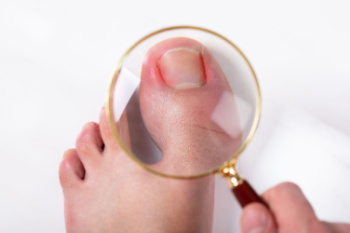 Onychocryptosis Is an Ingrown Toenail