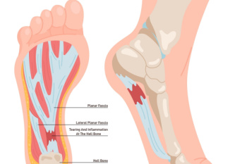 Risk Factors for Plantar Fasciitis