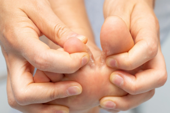 Treating Athlete’s Foot