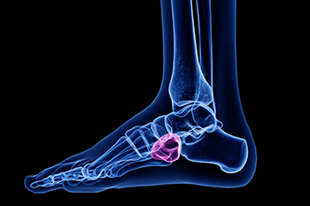 Understanding Cuboid Pain in Runners