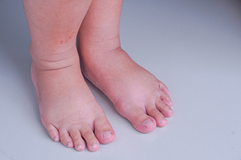 Why Swollen Feet Can Happen During Pregnancy