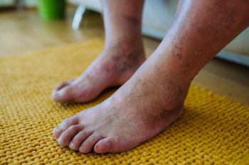 Understanding Diabetic Foot Problems