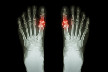 Dealing With Intense Joint Pain