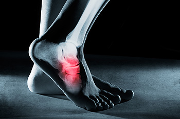 Causes of Foot Stress Fractures in Runners