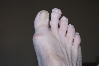 Why Pain Develops in the 2nd Toe