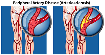 Recognizing Signs of Peripheral Artery Disease