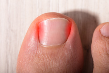 Pesky Ingrown Toenails