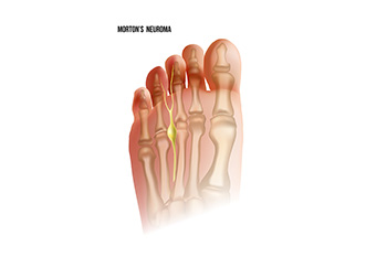 How to Recognize Symptoms of Morton’s Neuroma