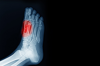 Common Causes of Sesamoiditis