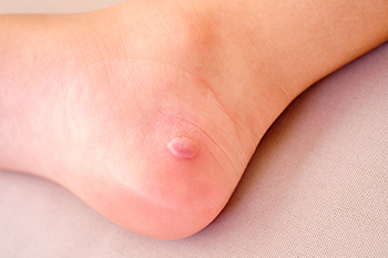 Diabetic Foot Blisters and Why Early Care Matters