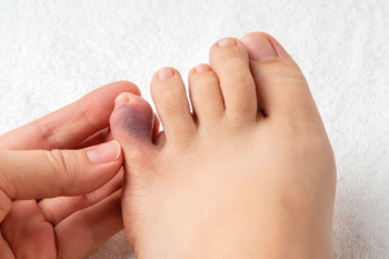 What Causes a Broken Toe?